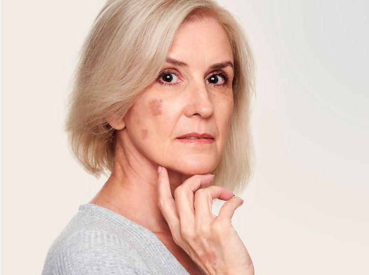 Hiperpigmentación en la piel: por qué se produce y cómo evitarla